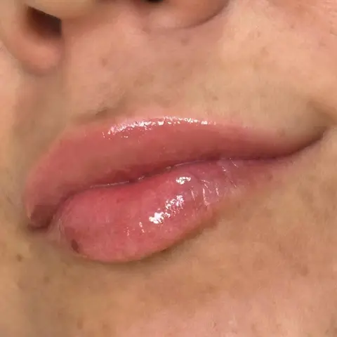 Regenera — Resultado 2 | Aurea Beauty X Studio Barretos
