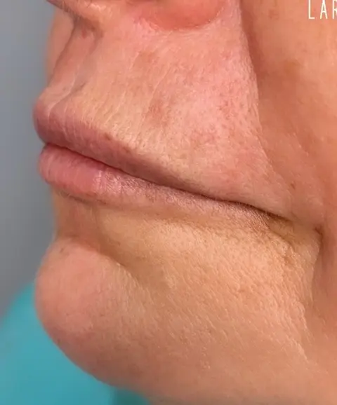 Epilação de Buço — Resultado | Aurea Beauty X Studio Barretos