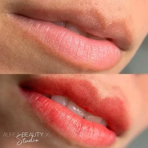 Revitalização Labial — Resultado 4 | Aurea Beauty X Studio Barretos